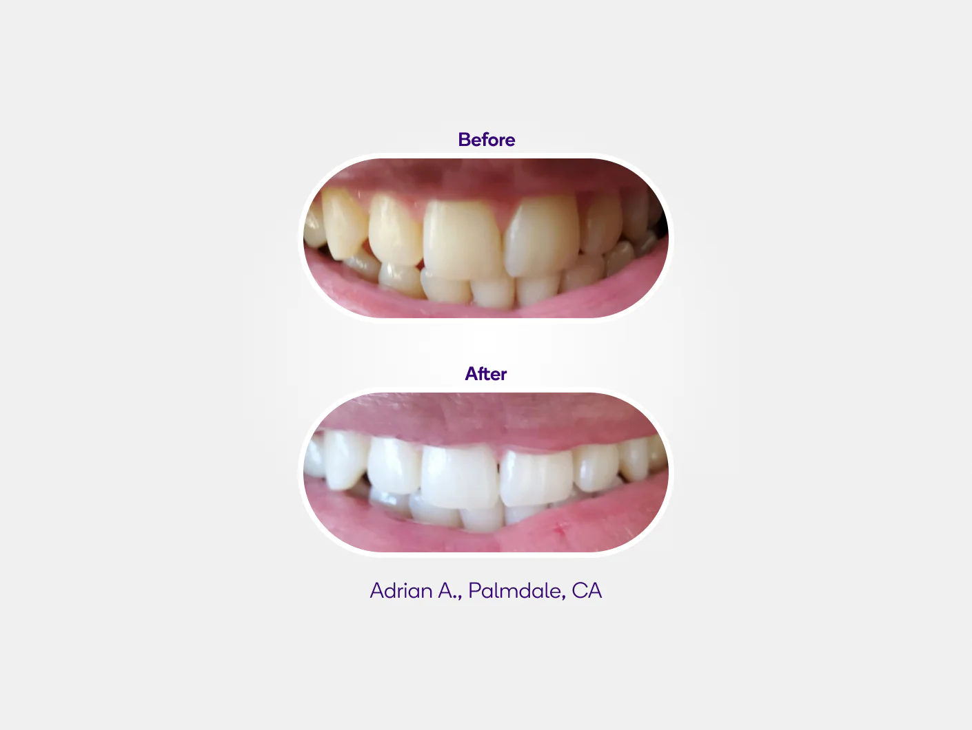 Prefilled Whitening Trays 3 pack Refill - Image 5